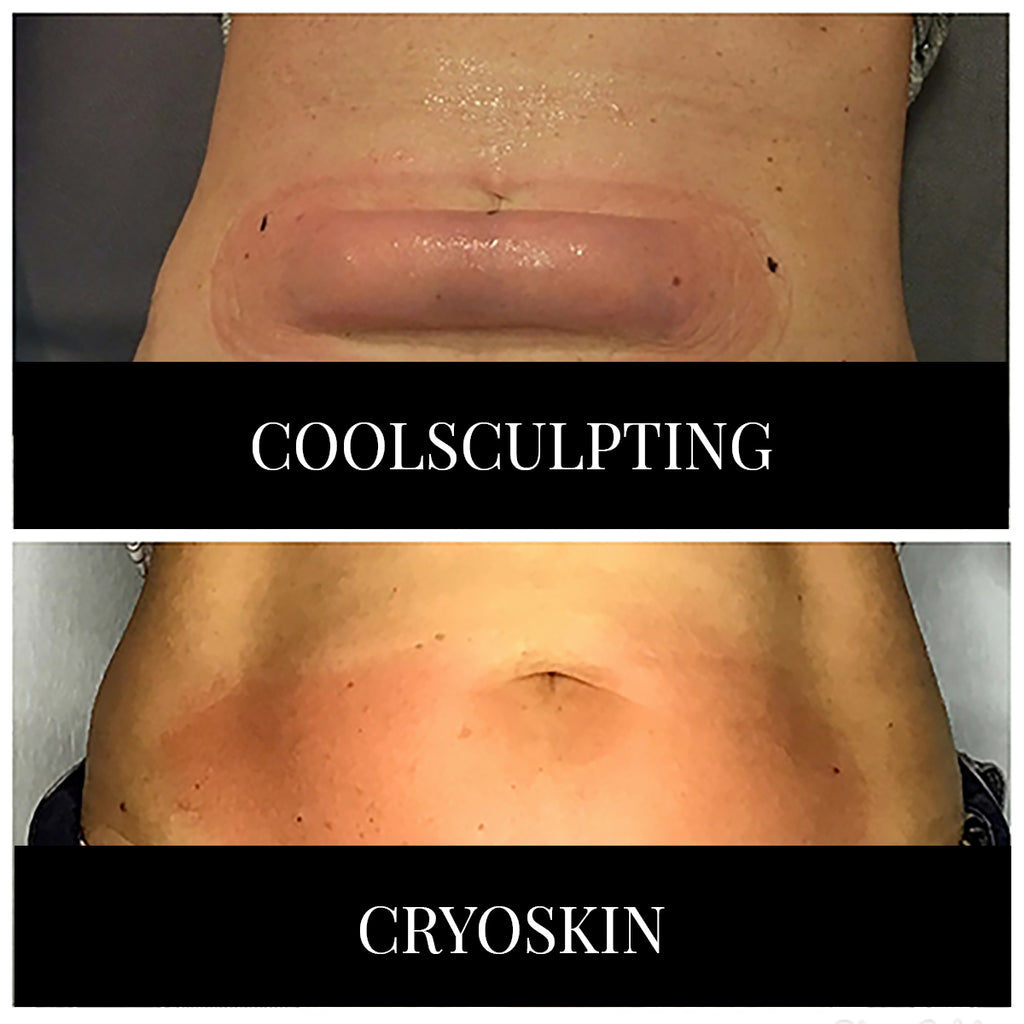 Coolsculpting vs Cryoskin...What's The Difference?