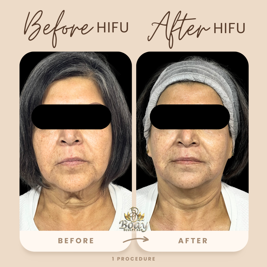 11D HIFU Full Facelift Introductory Offer | Non-Surgical Facelift